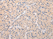 The image on the left is immunohistochemistry of paraffin-embedded Human liver cancer tissue using CSB-PA579827(ABCC1 Antibody) at dilution 1/20, on the right is treated with synthetic peptide. (Original magnification: ×200)