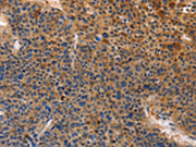 The image on the left is immunohistochemistry of paraffin-embedded Human liver cancer tissue using CSB-PA579873(MUSK Antibody) at dilution 1/30, on the right is treated with fusion protein. (Original magnification: ×200)