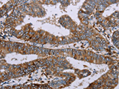 The image on the left is immunohistochemistry of paraffin-embedded Human colon cancer tissue using CSB-PA579941(AQP4 Antibody) at dilution 1/20, on the right is treated with synthetic peptide. (Original magnification: ×200)