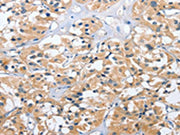 The image on the left is immunohistochemistry of paraffin-embedded Human thyroid cancer tissue using CSB-PA579990(UGCG Antibody) at dilution 1/40, on the right is treated with fusion protein. (Original magnification: ×200)