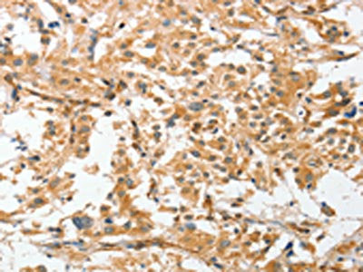 The image on the left is immunohistochemistry of paraffin-embedded Human thyroid cancer tissue using CSB-PA580017(ANGPTL7 Antibody) at dilution 1/30, on the right is treated with fusion protein. (Original magnification: ×200)