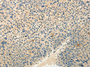 The image on the left is immunohistochemistry of paraffin-embedded Human liver cancer tissue using CSB-PA580068(RXFP3 Antibody) at dilution 1/30, on the right is treated with synthetic peptide. (Original magnification: ×200)