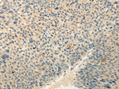 The image on the left is immunohistochemistry of paraffin-embedded Human liver cancer tissue using CSB-PA580068(RXFP3 Antibody) at dilution 1/30, on the right is treated with synthetic peptide. (Original magnification: ×200)