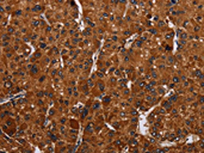 The image on the left is immunohistochemistry of paraffin-embedded Human liver cancer tissue using CSB-PA580390(RTN4R Antibody) at dilution 1/50, on the right is treated with synthetic peptide. (Original magnification: ×200)
