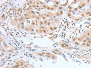The image on the left is immunohistochemistry of paraffin-embedded Human lung cancer tissue using CSB-PA580508(ATF2 Antibody) at dilution 1/15, on the right is treated with fusion protein. (Original magnification: ×200)