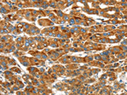 The image on the left is immunohistochemistry of paraffin-embedded Human liver cancer tissue using CSB-PA580639(ERP44 Antibody) at dilution 1/20, on the right is treated with synthetic peptide. (Original magnification: ×200)