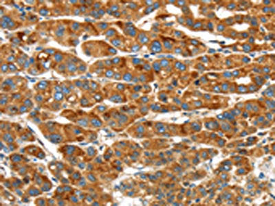 The image on the left is immunohistochemistry of paraffin-embedded Human liver cancer tissue using CSB-PA580639(ERP44 Antibody) at dilution 1/20, on the right is treated with synthetic peptide. (Original magnification: ×200)