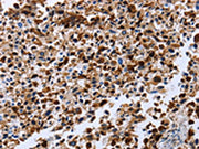The image on the left is immunohistochemistry of paraffin-embedded Human lung cancer tissue using CSB-PA580658(CXCR3 Antibody) at dilution 1/20, on the right is treated with synthetic peptide. (Original magnification: ×200)