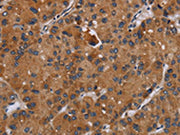 The image on the left is immunohistochemistry of paraffin-embedded Human liver cancer tissue using CSB-PA580837(DISC1 Antibody) at dilution 1/20, on the right is treated with synthetic peptide. (Original magnification: ×200)