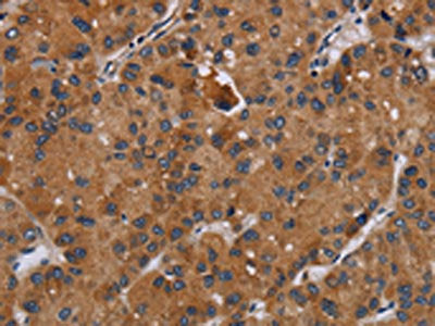 The image on the left is immunohistochemistry of paraffin-embedded Human liver cancer tissue using CSB-PA580837(DISC1 Antibody) at dilution 1/20, on the right is treated with synthetic peptide. (Original magnification: ×200)