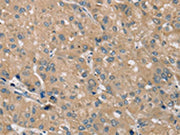The image on the left is immunohistochemistry of paraffin-embedded Human liver cancer tissue using CSB-PA580962(PRAF2 Antibody) at dilution 1/35, on the right is treated with synthetic peptide. (Original magnification: ×200)