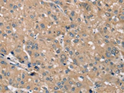The image on the left is immunohistochemistry of paraffin-embedded Human liver cancer tissue using CSB-PA580962(PRAF2 Antibody) at dilution 1/35, on the right is treated with synthetic peptide. (Original magnification: ×200)