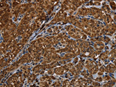 The image on the left is immunohistochemistry of paraffin-embedded Human thyroid cancer tissue using CSB-PA581084(HSD17B13 Antibody) at dilution 1/30, on the right is treated with fusion protein. (Original magnification: ×200)