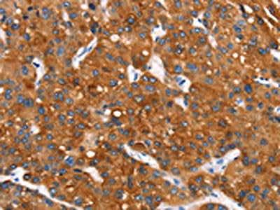 The image on the left is immunohistochemistry of paraffin-embedded Human liver cancer tissue using CSB-PA581286(MT-CYB Antibody) at dilution 1/30, on the right is treated with synthetic peptide. (Original magnification: ×200)