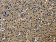 The image is immunohistochemistry of paraffin-embedded Human liver cancer tissue using CSB-PA581290(CORO1C Antibody) at dilution 1/60. (Original magnification: ×200)