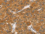 The image on the left is immunohistochemistry of paraffin-embedded Human liver cancer tissue using CSB-PA581560(SRGAP1 Antibody) at dilution 1/35, on the right is treated with synthetic peptide. (Original magnification: ×200)