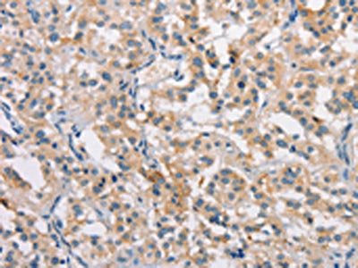 The image on the left is immunohistochemistry of paraffin-embedded Human thyroid cancer tissue using CSB-PA581946(CLDN11 Antibody) at dilution 1/25, on the right is treated with synthetic peptide. (Original magnification: ×200)