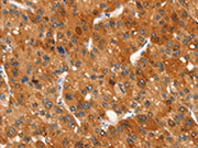 The image on the left is immunohistochemistry of paraffin-embedded Human liver cancer tissue using CSB-PA582009(CLEC6A Antibody) at dilution 1/20, on the right is treated with synthetic peptide. (Original magnification: ×200)