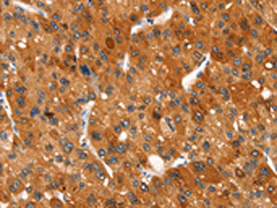 The image on the left is immunohistochemistry of paraffin-embedded Human liver cancer tissue using CSB-PA582009(CLEC6A Antibody) at dilution 1/20, on the right is treated with synthetic peptide. (Original magnification: ×200)