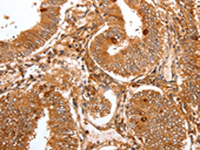 The image on the left is immunohistochemistry of paraffin-embedded Human cervical cancer tissue using CSB-PA582057(FOXO3 Antibody) at dilution 1/22, on the right is treated with synthetic peptide. (Original magnification: ×200)