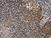 The image is immunohistochemistry of paraffin-embedded Human cervical cancer tissue using CSB-PA582088(STAT1 Antibody) at dilution 1/20. (Original magnification: ×200)