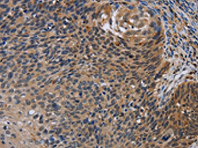 The image is immunohistochemistry of paraffin-embedded Human cervical cancer tissue using CSB-PA582088(STAT1 Antibody) at dilution 1/20. (Original magnification: ×200)