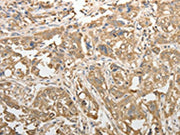 The image on the left is immunohistochemistry of paraffin-embedded Human esophagus cancer tissue using CSB-PA582160(ADHFE1 Antibody) at dilution 1/50, on the right is treated with synthetic peptide. (Original magnification: ×200)