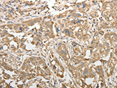 The image on the left is immunohistochemistry of paraffin-embedded Human esophagus cancer tissue using CSB-PA582160(ADHFE1 Antibody) at dilution 1/50, on the right is treated with synthetic peptide. (Original magnification: ×200)