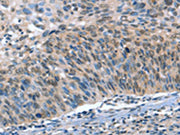 The image on the left is immunohistochemistry of paraffin-embedded Human cervical cancer tissue using CSB-PA582185(CAMTA1 Antibody) at dilution 1/15, on the right is treated with synthetic peptide. (Original magnification: ×200)