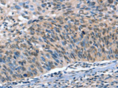 The image on the left is immunohistochemistry of paraffin-embedded Human cervical cancer tissue using CSB-PA582185(CAMTA1 Antibody) at dilution 1/15, on the right is treated with synthetic peptide. (Original magnification: ×200)