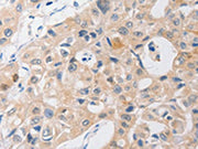 The image on the left is immunohistochemistry of paraffin-embedded Human lung cancer tissue using CSB-PA582272(P2RY11 Antibody) at dilution 1/40, on the right is treated with synthetic peptide. (Original magnification: ×200)