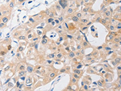 The image on the left is immunohistochemistry of paraffin-embedded Human lung cancer tissue using CSB-PA582272(P2RY11 Antibody) at dilution 1/40, on the right is treated with synthetic peptide. (Original magnification: ×200)