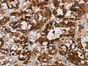 The image is immunohistochemistry of paraffin-embedded Human thyroid cancer tissue using CSB-PA582788(BCL2L12 Antibody) at dilution 1/20. (Original magnification: ×200)
