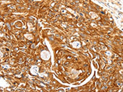 The image on the left is immunohistochemistry of paraffin-embedded Human esophagus cancer tissue using CSB-PA582909(SFTPA1 Antibody) at dilution 1/30, on the right is treated with synthetic peptide. (Original magnification: ×200)