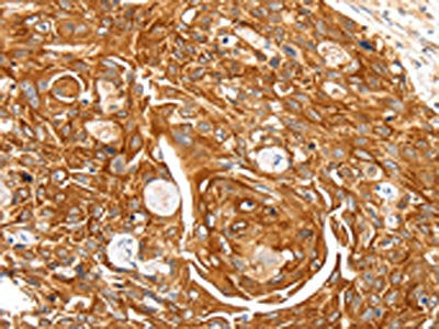 The image on the left is immunohistochemistry of paraffin-embedded Human esophagus cancer tissue using CSB-PA582909(SFTPA1 Antibody) at dilution 1/30, on the right is treated with synthetic peptide. (Original magnification: ×200)