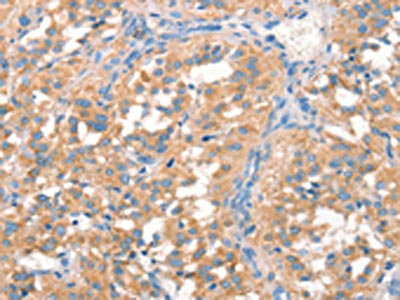The image on the left is immunohistochemistry of paraffin-embedded Human thyroid cancer tissue using CSB-PA583001(PRPS1/2/1L1 Antibody) at dilution 1/50, on the right is treated with synthetic peptide. (Original magnification: ×200)