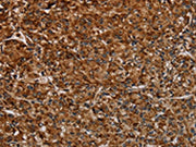 The image on the left is immunohistochemistry of paraffin-embedded Human prostate cancer tissue using CSB-PA583070(NDUFAB1 Antibody) at dilution 1/40, on the right is treated with synthetic peptide. (Original magnification: ×200)