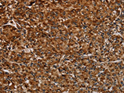 The image on the left is immunohistochemistry of paraffin-embedded Human prostate cancer tissue using CSB-PA583070(NDUFAB1 Antibody) at dilution 1/40, on the right is treated with synthetic peptide. (Original magnification: ×200)