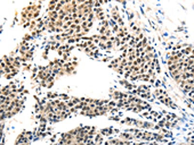 The image on the left is immunohistochemistry of paraffin-embedded Human liver cancer tissue using CSB-PA583147(MAGEA6 Antibody) at dilution 1/120, on the right is treated with synthetic peptide. (Original magnification: ×200)