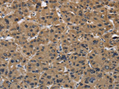 The image on the left is immunohistochemistry of paraffin-embedded Human liver cancer tissue using CSB-PA583154(FABP2 Antibody) at dilution 1/40, on the right is treated with synthetic peptide. (Original magnification: ×200)