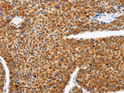 The image on the left is immunohistochemistry of paraffin-embedded Human liver cancer tissue using CSB-PA583273(SPATA13 Antibody) at dilution 1/25, on the right is treated with fusion protein. (Original magnification: ×200)