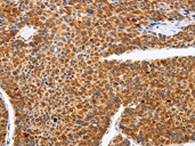 The image on the left is immunohistochemistry of paraffin-embedded Human liver cancer tissue using CSB-PA583273(SPATA13 Antibody) at dilution 1/25, on the right is treated with fusion protein. (Original magnification: ×200)