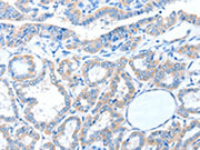 The image on the left is immunohistochemistry of paraffin-embedded Human thyroid cancer tissue using CSB-PA583376(ADAM21 Antibody) at dilution 1/15, on the right is treated with fusion protein. (Original magnification: ×200)