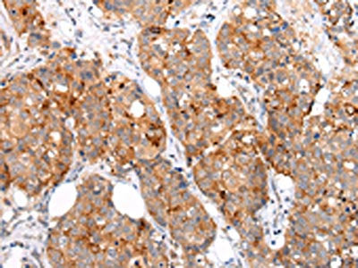 The image on the left is immunohistochemistry of paraffin-embedded Human breast cancer tissue using CSB-PA583379(MUC1(CT) Antibody) at dilution 1/20, on the right is treated with synthetic peptide. (Original magnification: ×200)