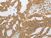The image on the left is immunohistochemistry of paraffin-embedded Human ovarian cancer tissue using CSB-PA583461(GRIN2C Antibody) at dilution 1/80, on the right is treated with synthetic peptide. (Original magnification: ×200)