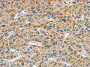 The image on the left is immunohistochemistry of paraffin-embedded Human liver cancer tissue using CSB-PA583502(LPAR1 Antibody) at dilution 1/20, on the right is treated with synthetic peptide. (Original magnification: ×200)