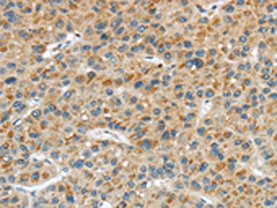 The image on the left is immunohistochemistry of paraffin-embedded Human liver cancer tissue using CSB-PA583502(LPAR1 Antibody) at dilution 1/20, on the right is treated with synthetic peptide. (Original magnification: ×200)