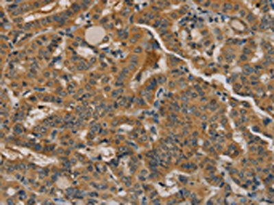 The image on the left is immunohistochemistry of paraffin-embedded Human thyroid cancer tissue using CSB-PA583509(NANOS2 Antibody) at dilution 1/20, on the right is treated with fusion protein. (Original magnification: ×200)