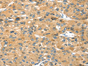 The image on the left is immunohistochemistry of paraffin-embedded Human liver cancer tissue using CSB-PA583633(SEPP1 Antibody) at dilution 1/35, on the right is treated with fusion protein. (Original magnification: ×200)