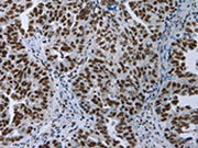 The image on the left is immunohistochemistry of paraffin-embedded Human ovarian cancer tissue using CSB-PA583825(ELN Antibody) at dilution 1/50, on the right is treated with fusion protein. (Original magnification: ×200)